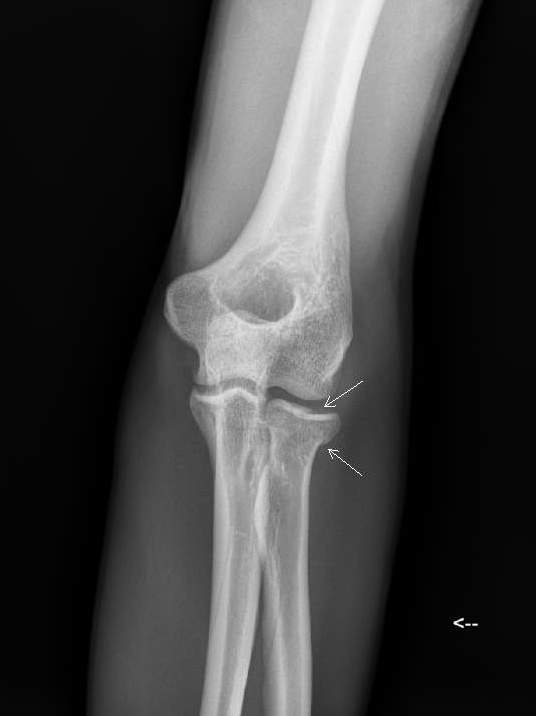 x-ray of fractured radial head