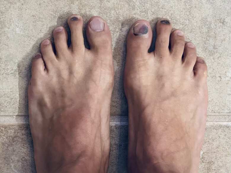 Thumbnail for Runner’s Toe: How Long Does It Take for Black Toenails to Clear Up, and How to Prevent Them