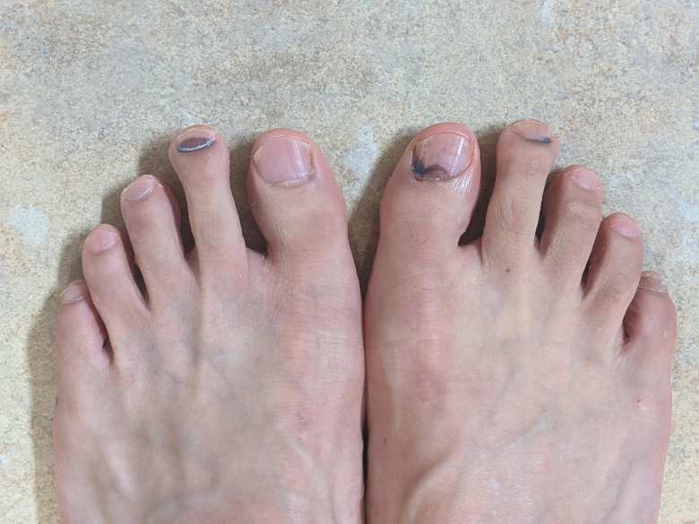 I got four black toenails after the Maritime Marathon. (The fourth was the pinky toe of the right foot, but the blackened portion was too low to be seen in this photo.)