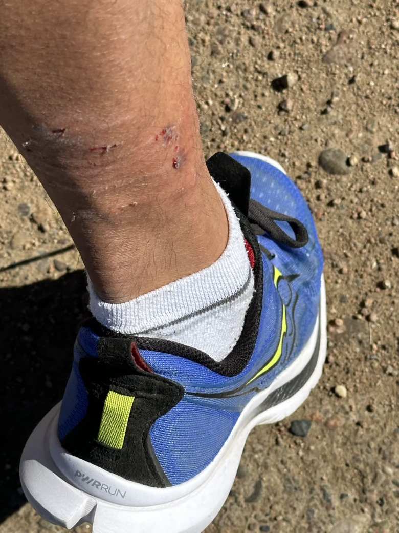 My first dog bite ever.