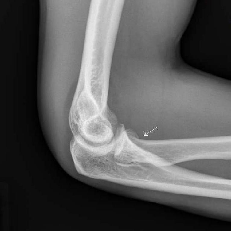 x-ray of fractured elbow