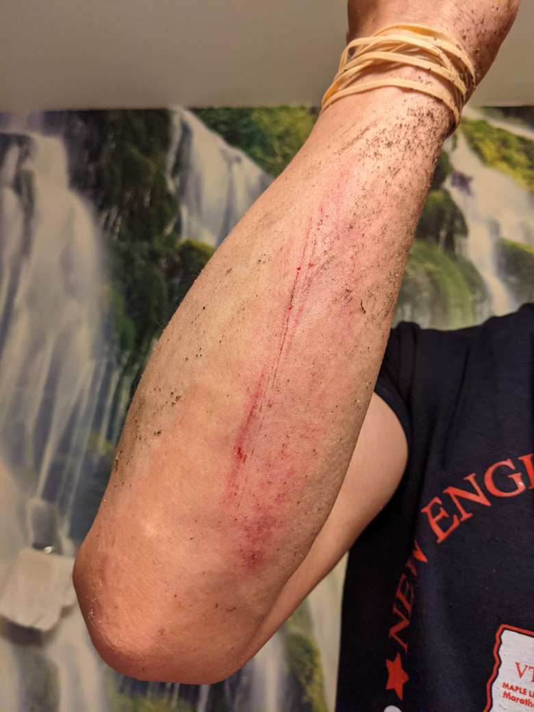 Felix Wong's bloodied arm after falling with a mere quarter-mile to go in the Mainly Marathons Independence Series 26.2-miler in Delaware.