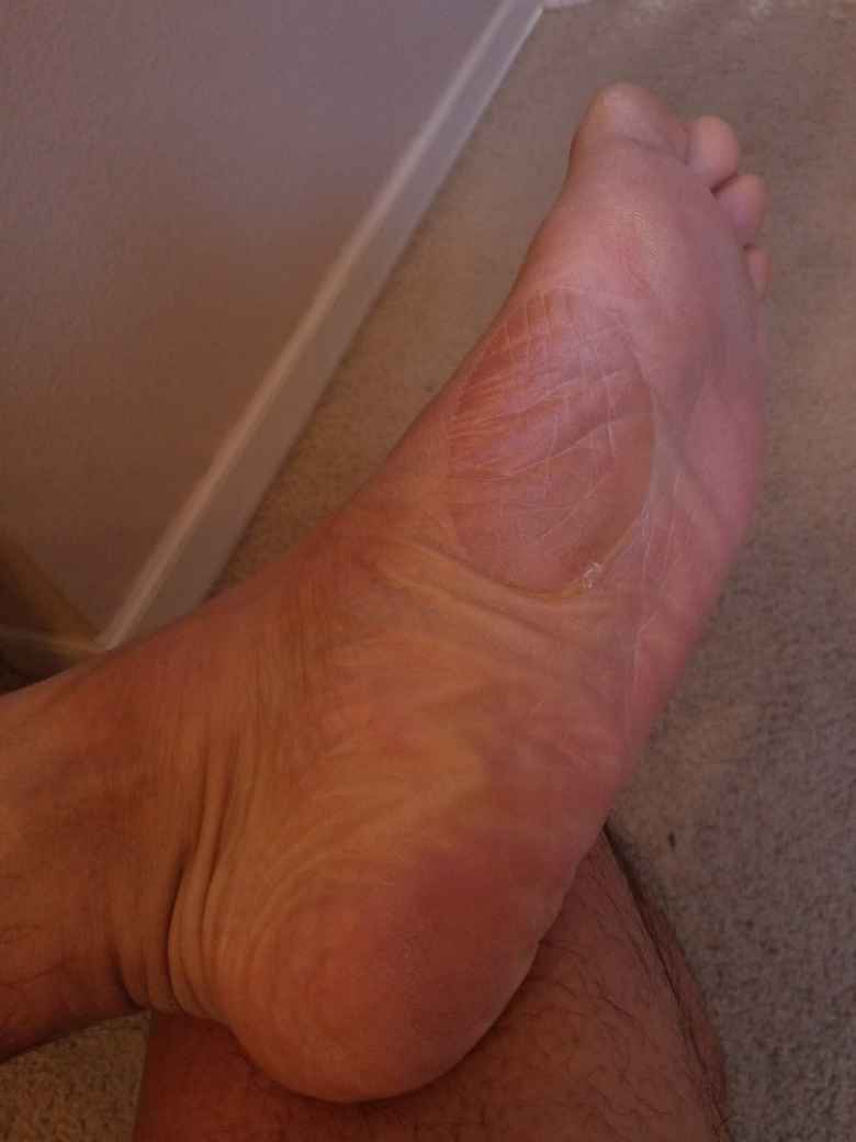 The huge blister on my left foot that developed during the 2020 Run Hard Columbia Marathon.