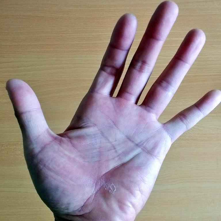 Felix Wong's hand, peeling skin, hot spots, 2015 Trans Am Bike Race